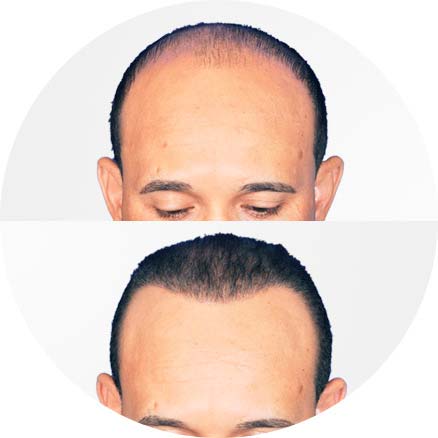 SmartGraft - Before and After Treatment photos - man patient (front view)