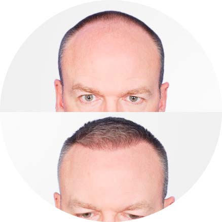 SmartGraft - Before and After Treatment photos - male patient (front view)