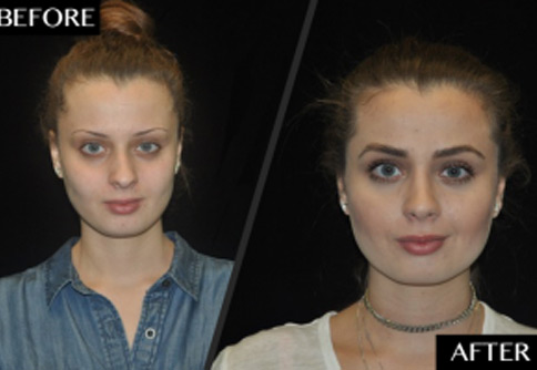 SmartGraft - Before and After Photos - Move Over Microblading